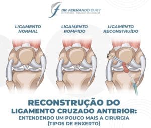 Ligamento Cruzado Anterior