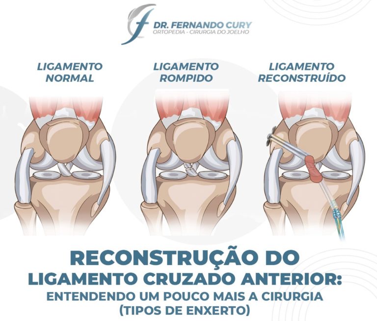 Arquivos Les O Do Ligamento Cruzado Anterior Dr Fernando Cury Rezende